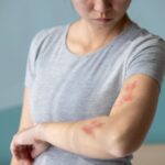 shingles