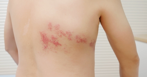 shingles