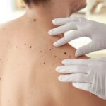 warning signs melanoma dr maria swetech