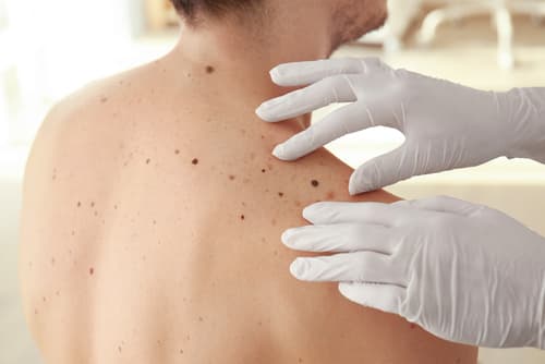 warning signs melanoma dr maria swetech